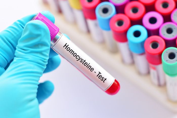Homocysteina – coraz lepiej poznawany czynnik ryzyka wielu chorób